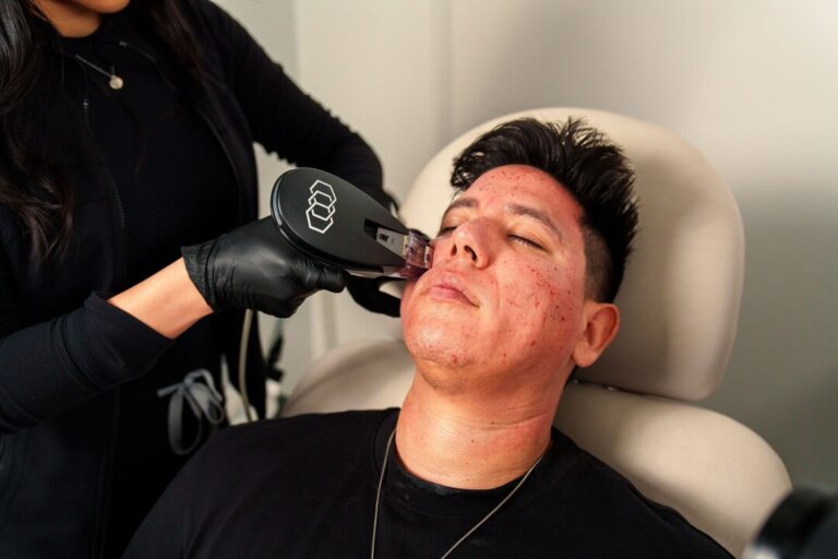 male patient receiving rf microneedling treatment